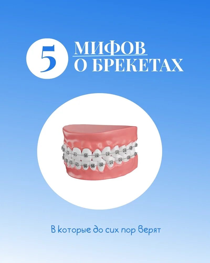5 мифов о брекетах — 1