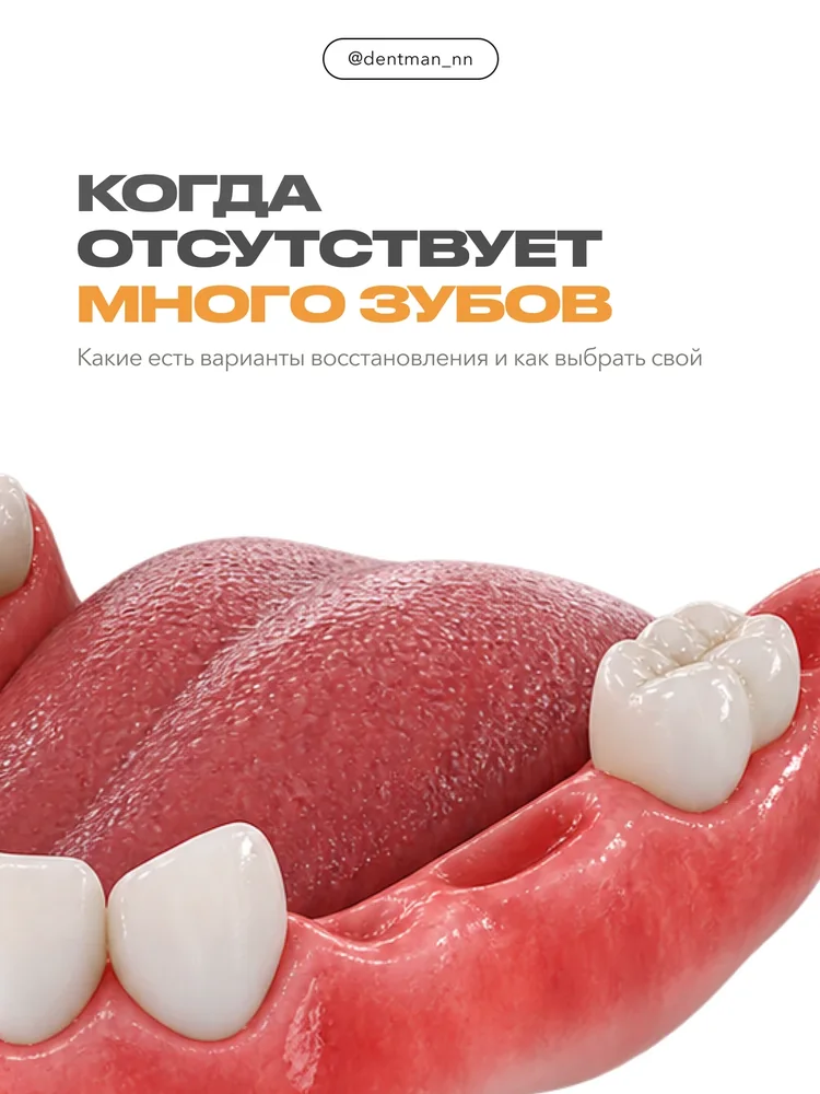 Когда отсутствует много зубов — 1