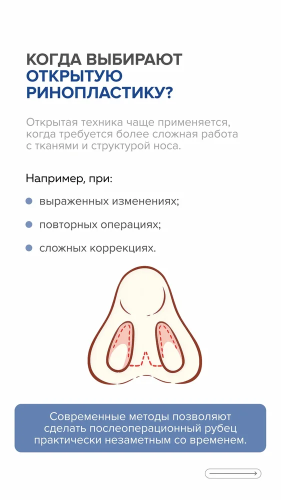 Ринопластика: открытая или закрытая — 2