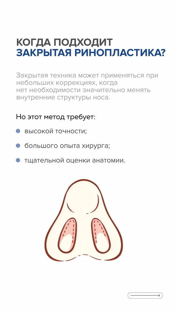 Ринопластика: открытая или закрытая — 3